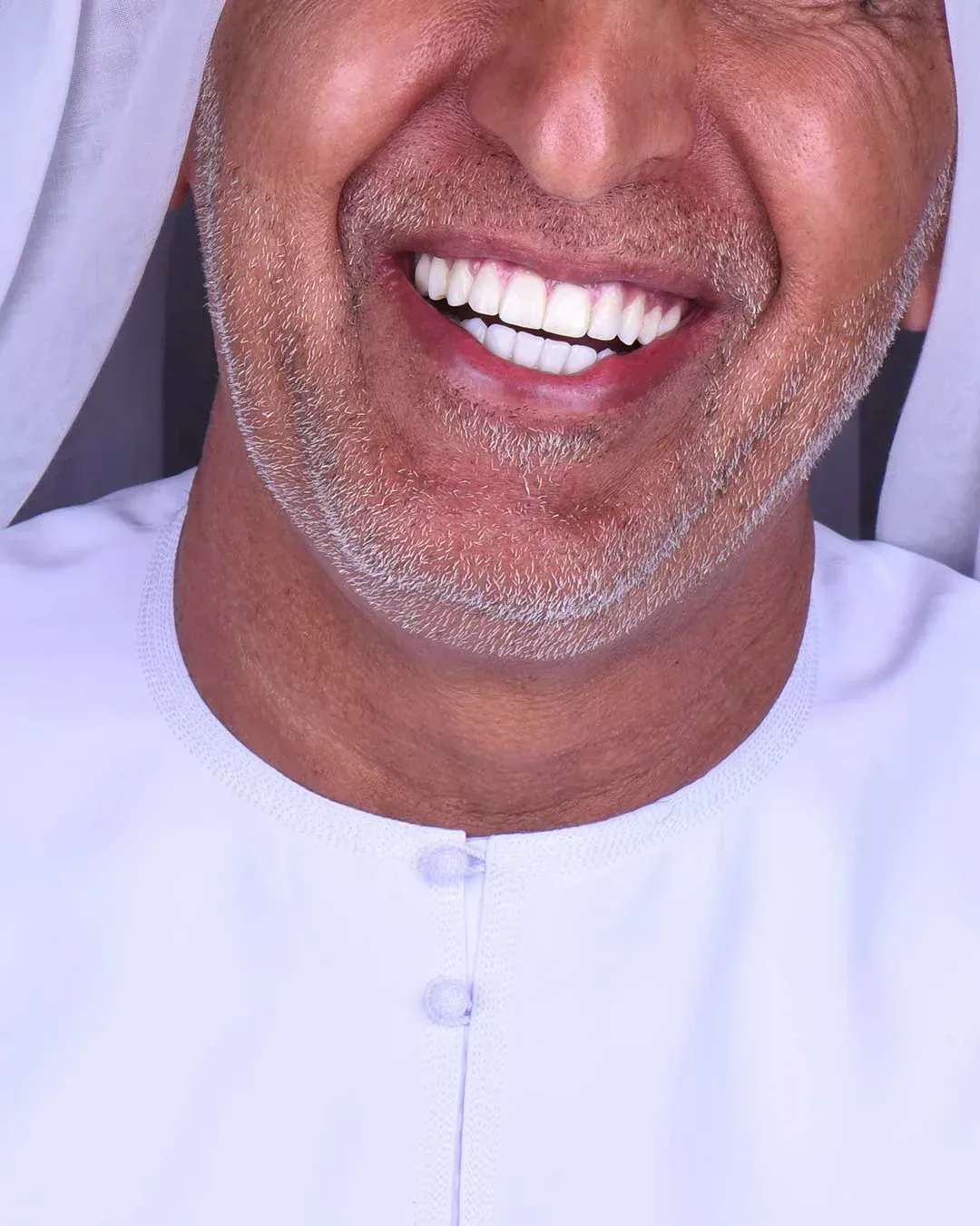 all on 6 dental implants dubai