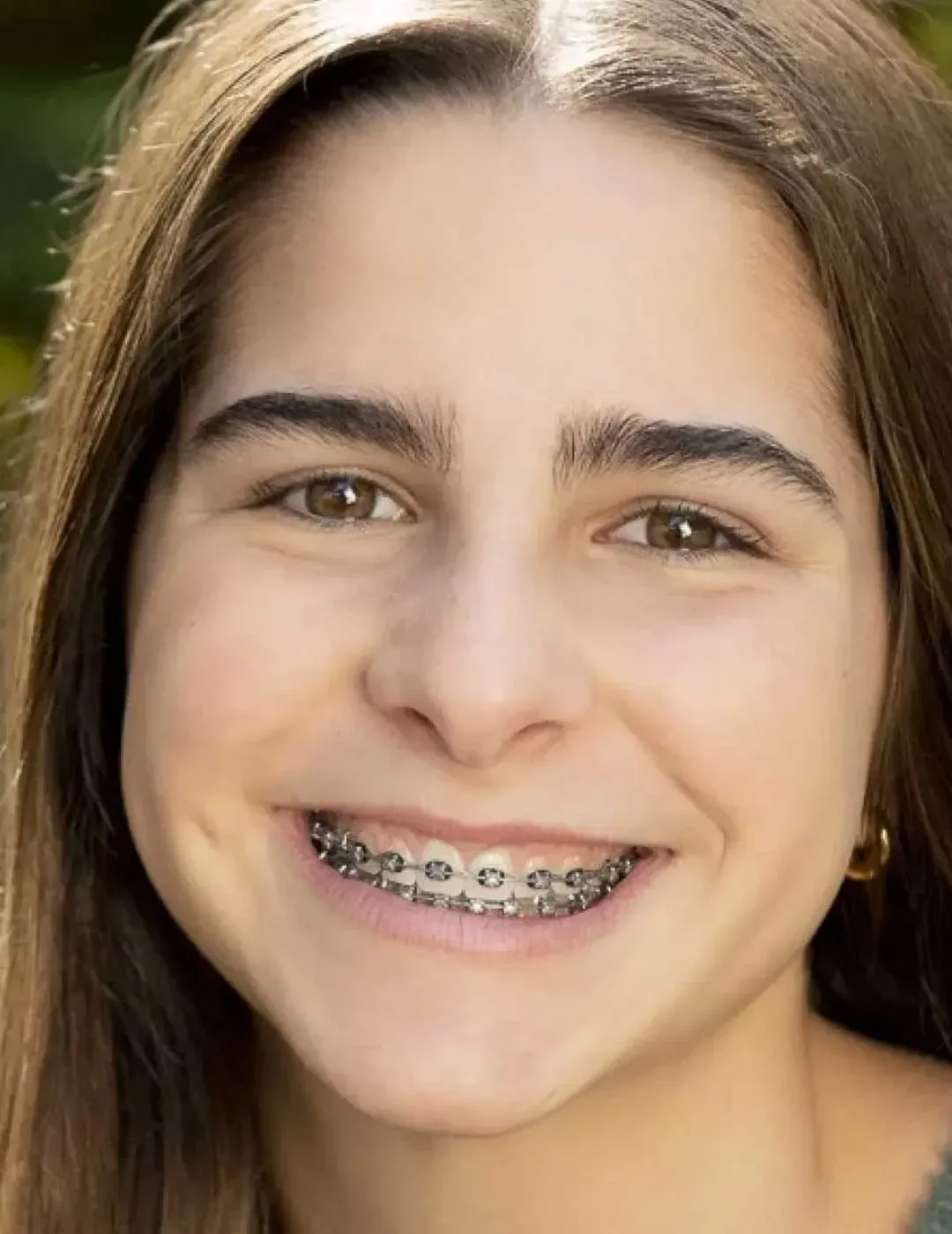 Beautiful teenager girl smiling with Damon braces
