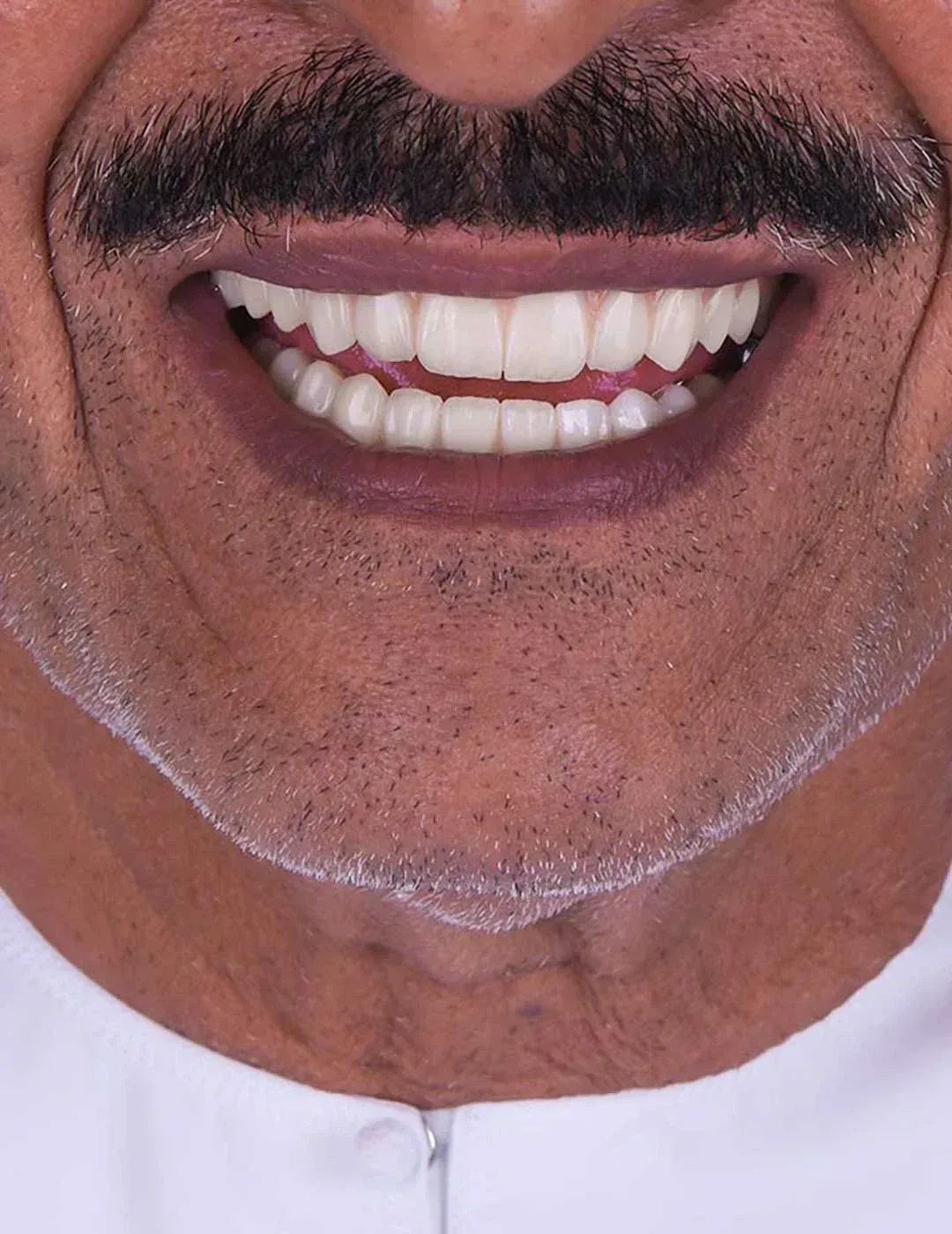 all on 4 dental implants