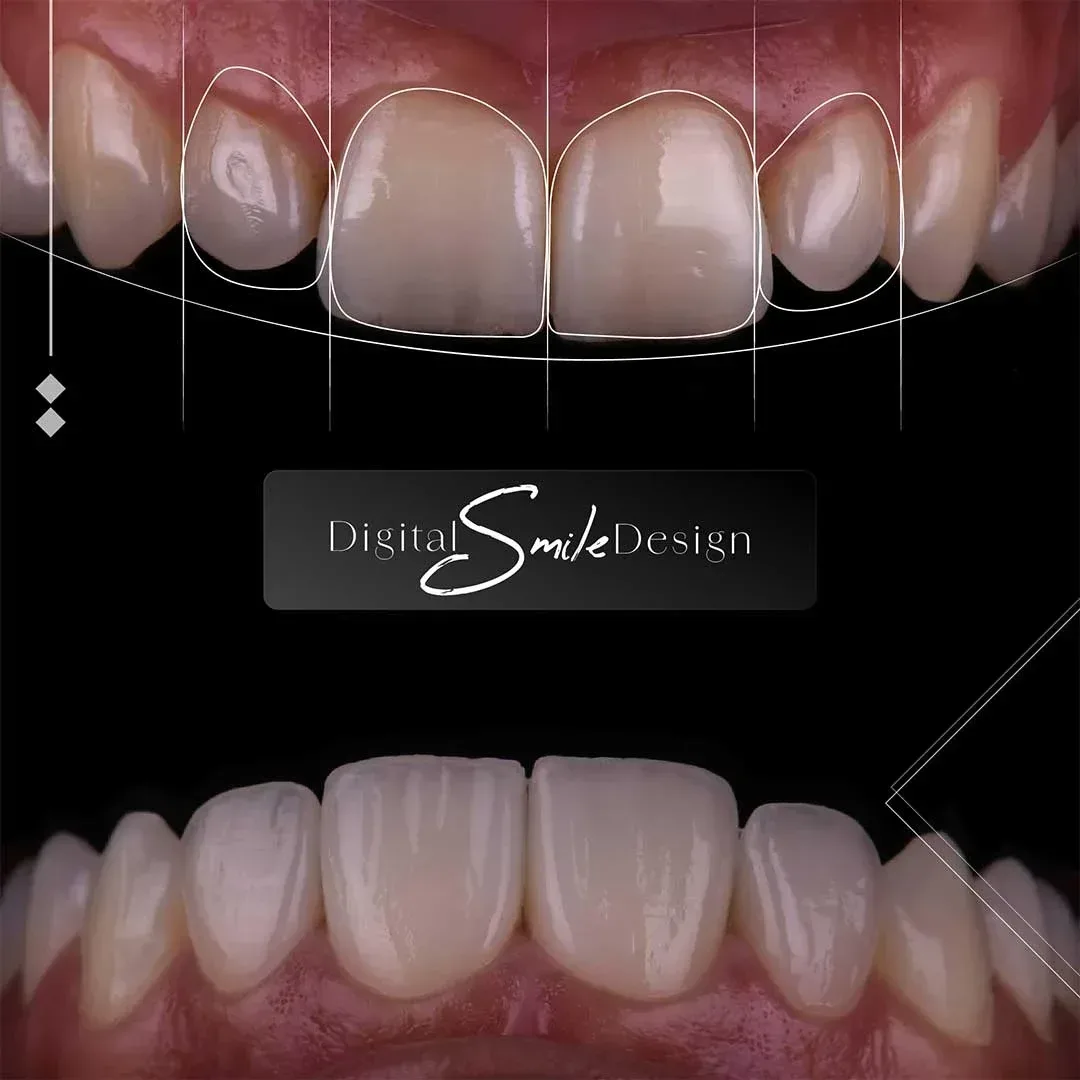 Before and after photo of a smile transformation using Digital Smile Design at Harmony Medical Center.