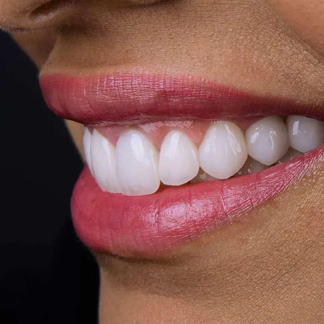 In-office teeth whitening abu dhabi