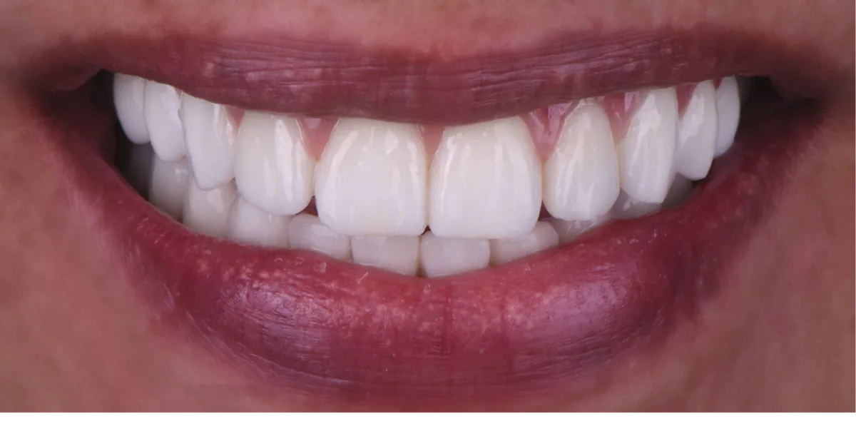 full set dental implants near me